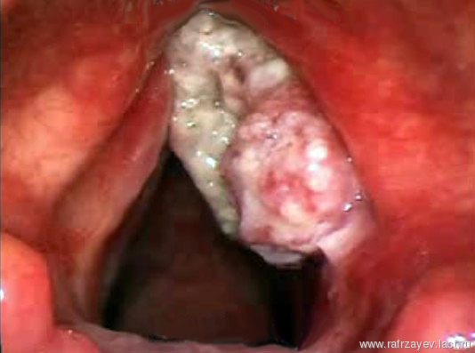 Папилломы в горле – лечение папилломатоза гортани