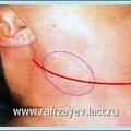 Наклонный разрез кожи от верхушки сосцевидного отростка до уровня верхнего края щитовидного хряща