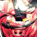 Вид операционной раны в момент задней тампонады носа у больного после удаления I категории опухоли, доступом через нёба