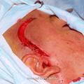 Вид линии разреза при выполнении микрохирургической операции на основании черепа