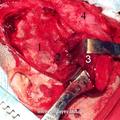 Вид операционной раны после обнажения подвисочной ямки (1-чешуя височной кости; 2-височная ямка; 3-мобилизованная височная мышца; 4-кожный лоскут)