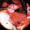 Момент завершения отсепаровки интракраниального отростка опухоли (микроскоп) (Т-опухоль)