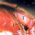 Момент отсепаровки опухоли в средней черепной ямке (микроскоп) (Т-опухоль; 1-F. laserum; 2-F. ovale)