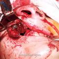 в) Момент удаления опухоли у больного со II категорией опухоли, доступом через верхнечелюстную пазуху и полость носа с проведением разреза под губой.