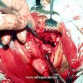 д) Вид операционной раны в момент удаления опухоли