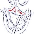 а) Отсепаровка мукопериостального лоскута твердого нёба