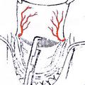 б) резекция заднего края нёбной кости и задне-внутреннего края большого нёбного отверстия