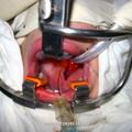 Инфильтрационная анестезия слизистой оболочки твёрдого нёба, обеспечивающая гидросепаровку мукопериостального лоскута.