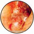 Обширно распространенная ЯБП (темпоральная): барабанная перепонка выпячена латерально, задненижняя часть костного отдела наружного слухового прохода частично разрушена. В верхне-переднем квадранте обозреваются короткий отросток молоточка и малая част