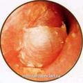 Обширно распространенная ЯБП (темпоральная): опухоль, разрушая барабанную перепонку, вторгается в костный отдел наружного слухового прохода.