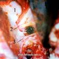 Вид операционной раны после расширения подвисочной ямки (микроскоп) [1-тело клиновидной кости; 2-нижнечелюстная ветвь тройничного нерва (V3); 3-средняя артерия твердой мозговой оболочки]