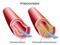 Атеросклероз. Факторы влияющие на развитие. Профилактика