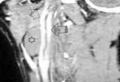 Киста (звездочка) правого парафарингеального пространства (боковая проекция): малая стрелка-наружная сонная артерия;большая стрелка-внутренняя сонная артерия