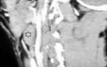 Киста (звездочка) правого парафарингеальго пространства (боковая проекция): стрелка-наружная сонная артерия