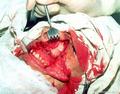 Операционная рана после обнажения поверхностей костей лицевого скелета 