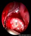 Мобилизация носового сегмента опухоли (сепарирование опухоли от структур решётчатой и нёбной костей:
T – опухоль;
1 – перегородка носа;
2 – медиальная стенка верхнечелюстной пазухи (вскрыта)