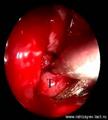 Мобилизация носоглоточного сегмента опухоли и выделение её из клиновидной пазухи (