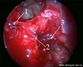 Деваскуляризация опухоли путём клипирования  верхнечелюстной артерии:
 
1 – клипсы наложены,  непосредственно на ствол   
       артерии (проксимально); 

С целью предотвращения ретроградного кровотока, наложены (дистально) две другие клипсы: 
2 – на