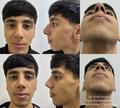 Ринопластика/Иллюстрация
