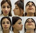 Ринопластика/Иллюстрация