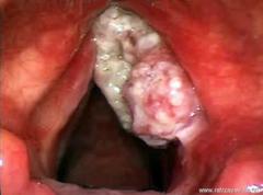Лечение больных ограниченным раком гортани (I-II стадии)