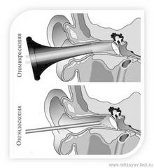 Эндоскопическая хирургия уха