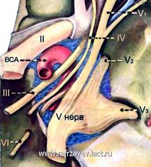 Топографо-анатомическое соотношение анатомических структур параселлярной области: кавернозного синуса, ВСА и ряд черепных нервов -  глазодвигательного (III), блокового (IV), отводящего (VI) нервов и глазничной ветви тройничного нерва (V1) 